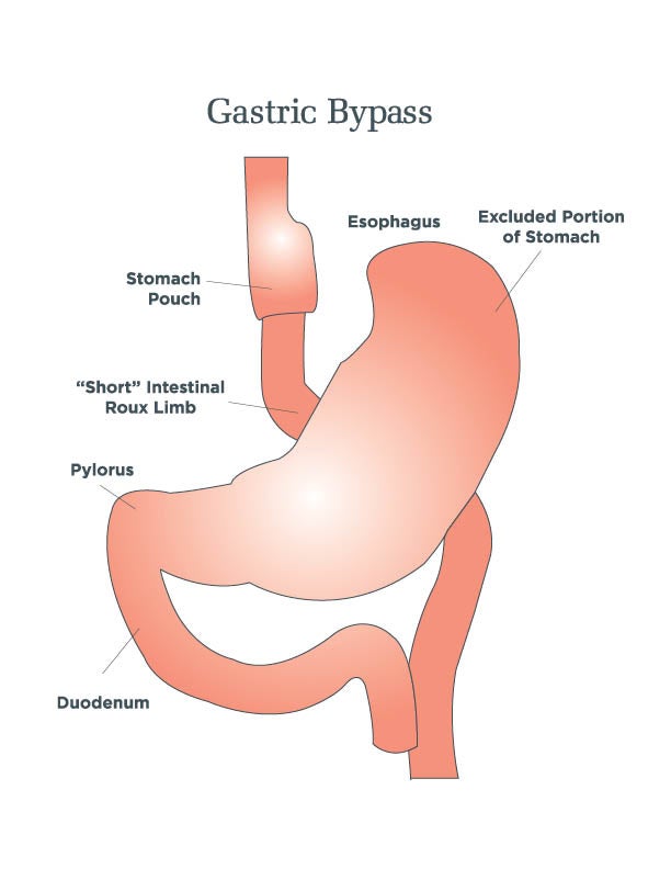 Roux En Y Gastric Bypass Bailey Bariatrics 